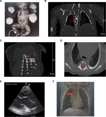 A novel homozygous HES7 splicing variant causing spondylocostal dysostosis 4: a case report